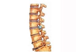 Faze razvoja cervikalne osteohondroze