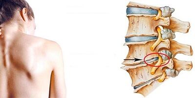 Mehanizam razvoja cervikalne osteohondroze