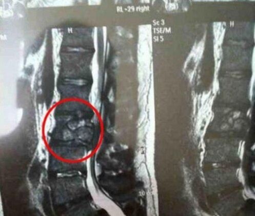 Tumor kralježnice na slici