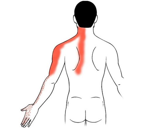 cervikalna osteokondroza kao uzrok boli u zglobovima prstiju