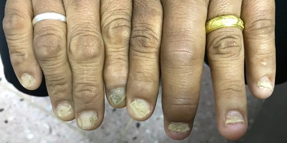Oticanje prstiju i deformacija ploče nokta mogu ukazivati ​​na razvoj psorijatičnog artritisa