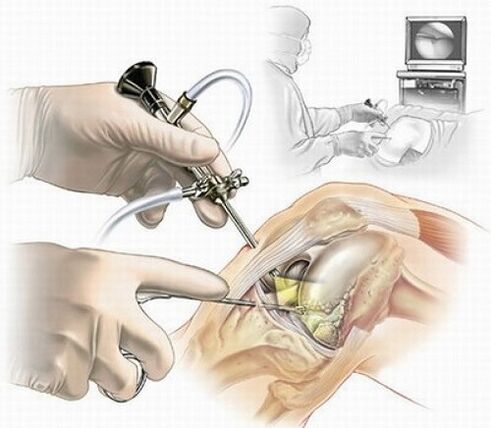 artroskopija koljena za osteoartritis